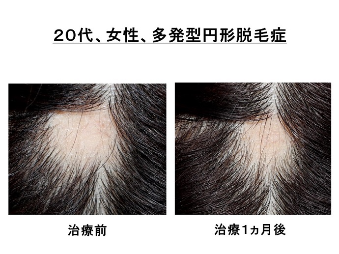 円形脱毛症　病院